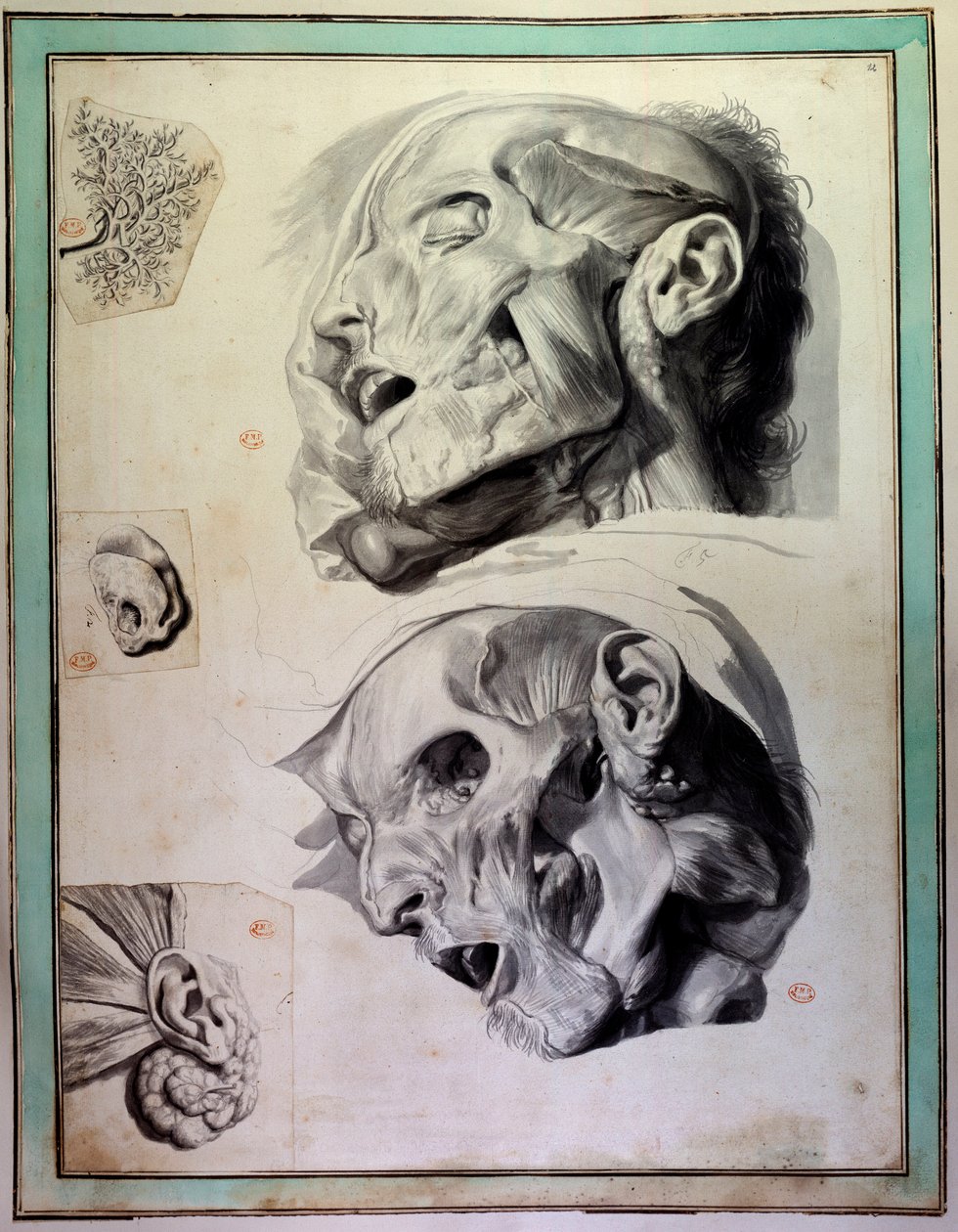 Kérgezett emberi fejek: láthatóak az izmok és a csontvázak. Gerard de Lairesse (1640-1711) metszet, amely Govert Bidloo (vagy Govard) (1649-1713) „Anatomia Humani Corporis” című művét illusztrálja, Párizs Orvostudományi Karának 18. századi könyvtára alkotó: Gerard de Lairesse