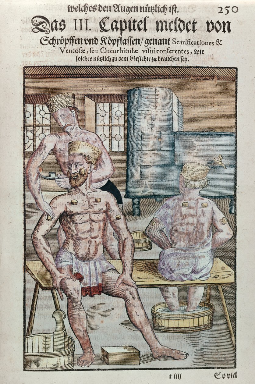 Georg Bartisch (1535-1636) köpölyözése, az Ophthalmodouleia-ból, Drezdában 1583-ban (színes fatömbnyomat) alkotó: German School