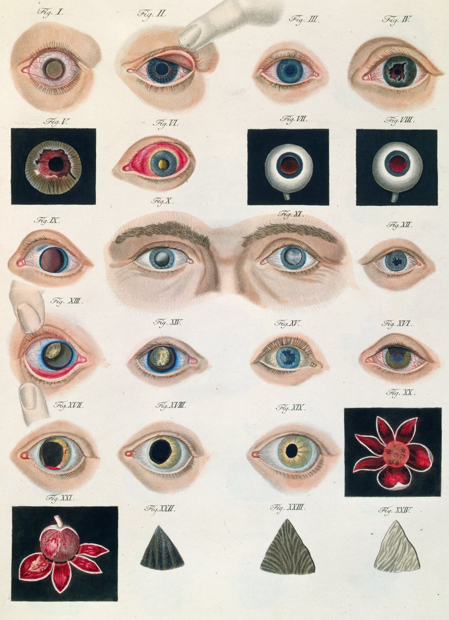 A veleszületett szem anomáliák leírása az emberi szem betegségeinek és látáshibáinak klinikai bemutatásából, Friedrich August von Ammon (1799-1861) 1838 alkotó: German School