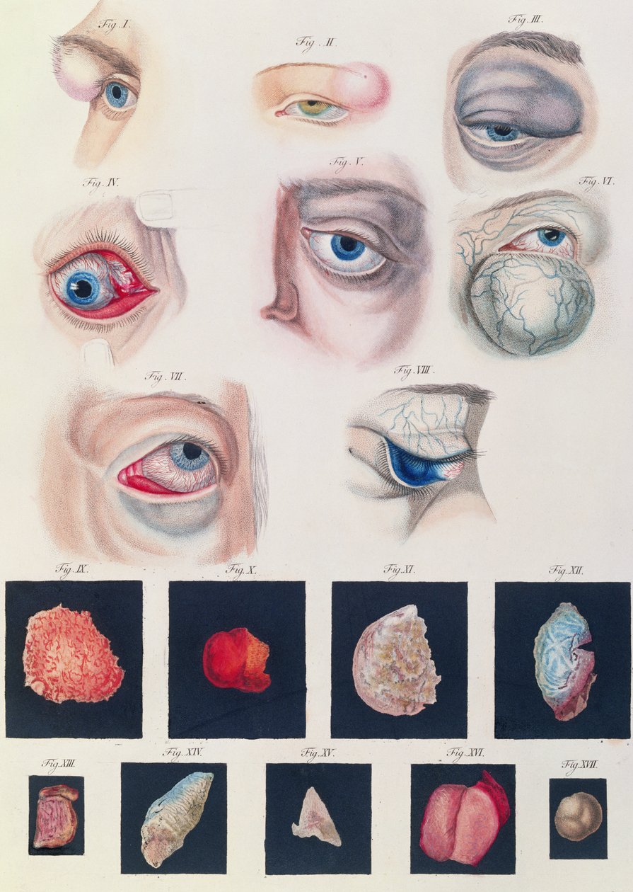 A veleszületett szem anomáliák leírása az emberi szem betegségeinek és látáshibáinak klinikai bemutatásából, Friedrich August von Ammon (1799-1861) 1838 alkotó: German School
