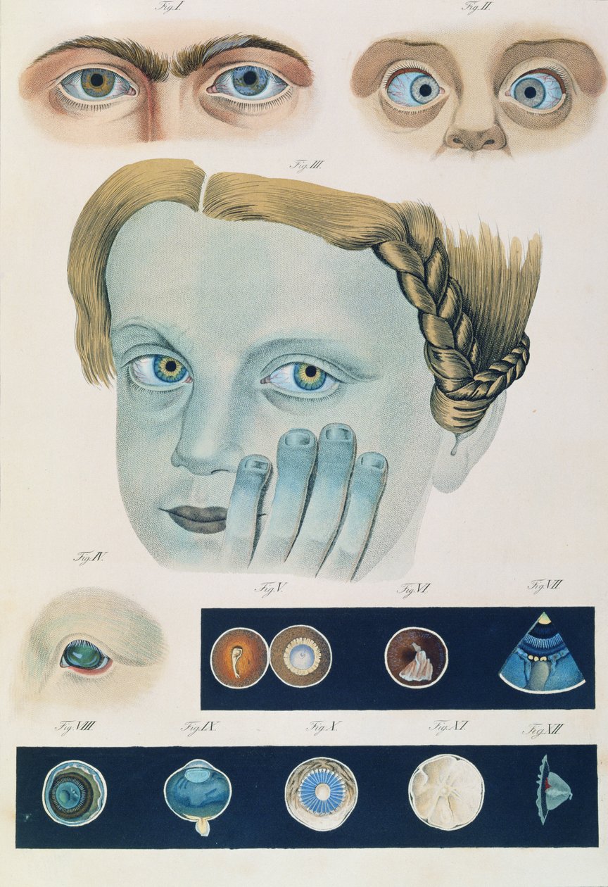 A veleszületett szem anomáliák leírása az emberi szem betegségeinek és látáshibáinak klinikai bemutatásából, Friedrich August von Ammon (1799-1861) 1838 alkotó: German School