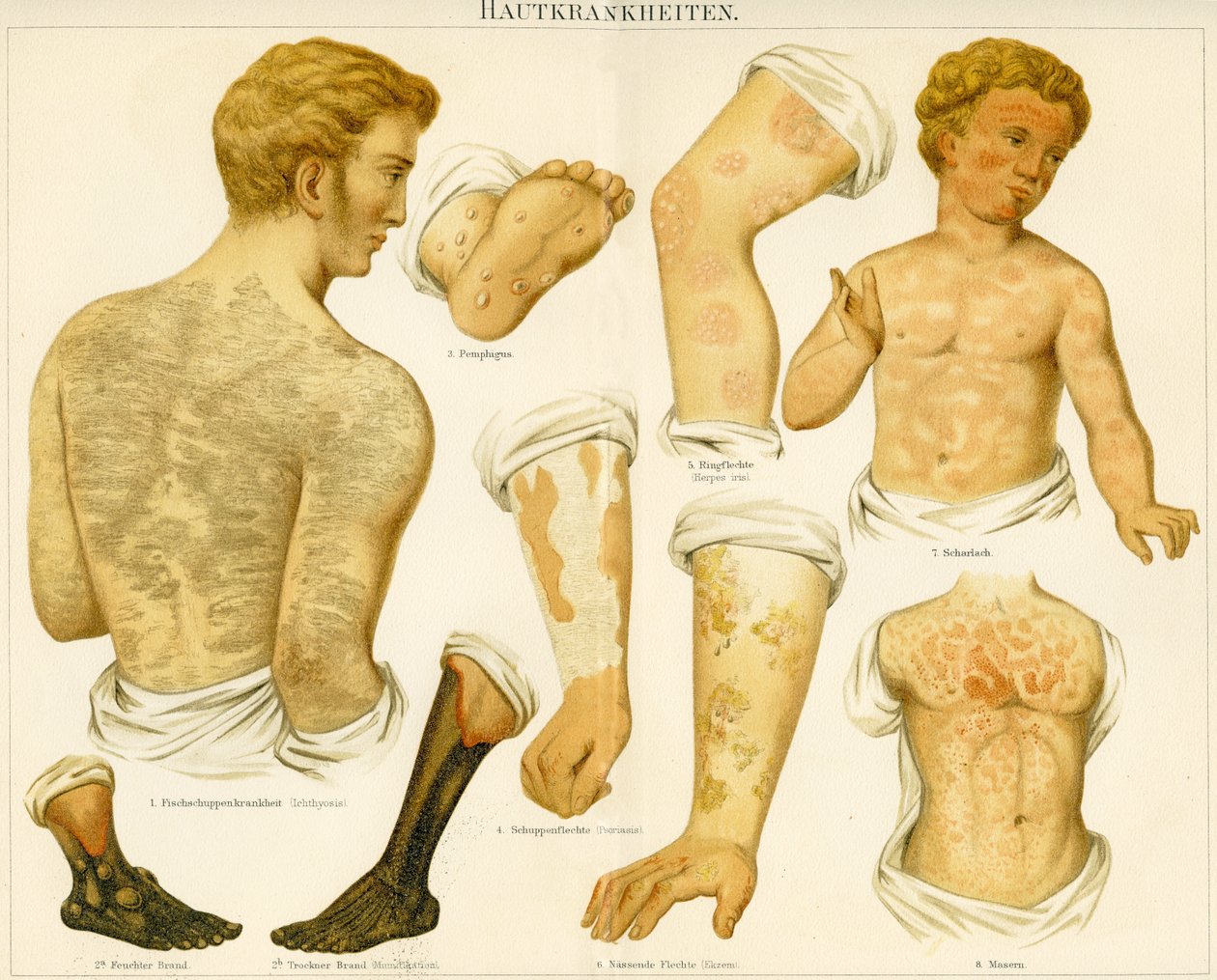 Bőrbetegségek, 1890 körül alkotó: German School