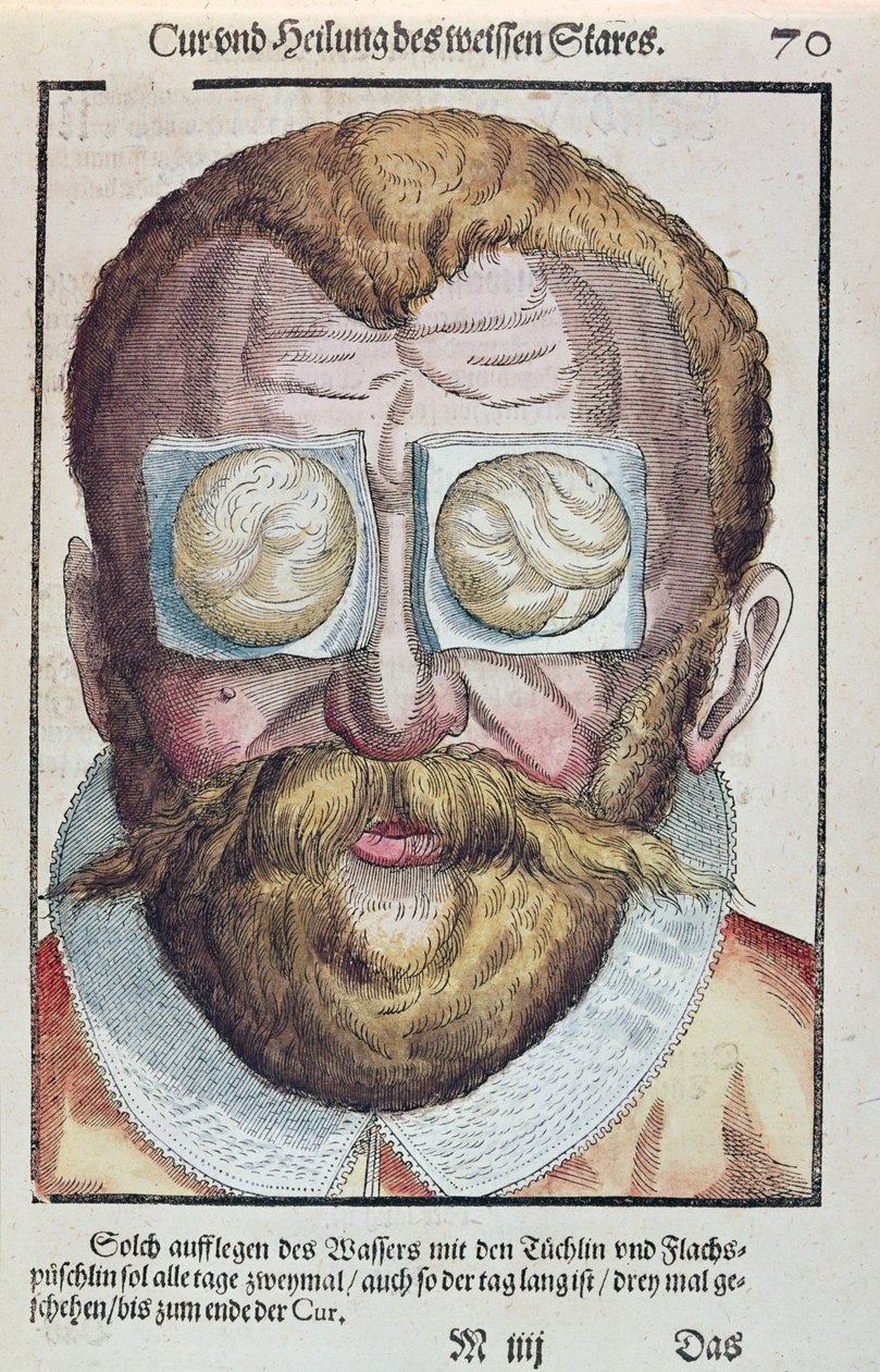 Szembetegség kezelése, Georg Bartisch (1535-1636) Ophthalmodouleia-ból, Drezdában 1583-ban (színes fatömbnyomat) alkotó: German School