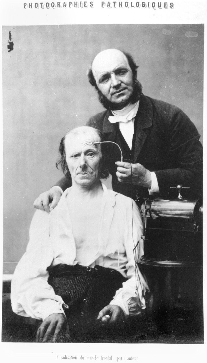 A frontális izom faradizációja, Duchenne de Boulogne „Album de photographies pathologiques” című könyvéből, 1862, Párizs alkotó: Guillaume Benjamin Armand Duchenne de Boulogne