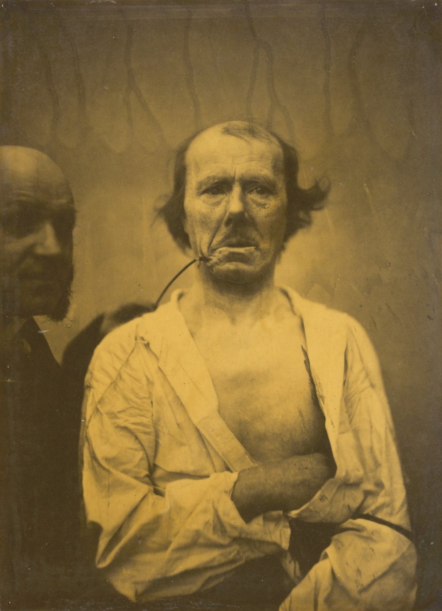 Nyugodt kifejezés (balra); undor (jobbra),1854-1856, nyomtatva 1862 (fotó) alkotó: Guillaume Benjamin Armand Duchenne de Boulogne