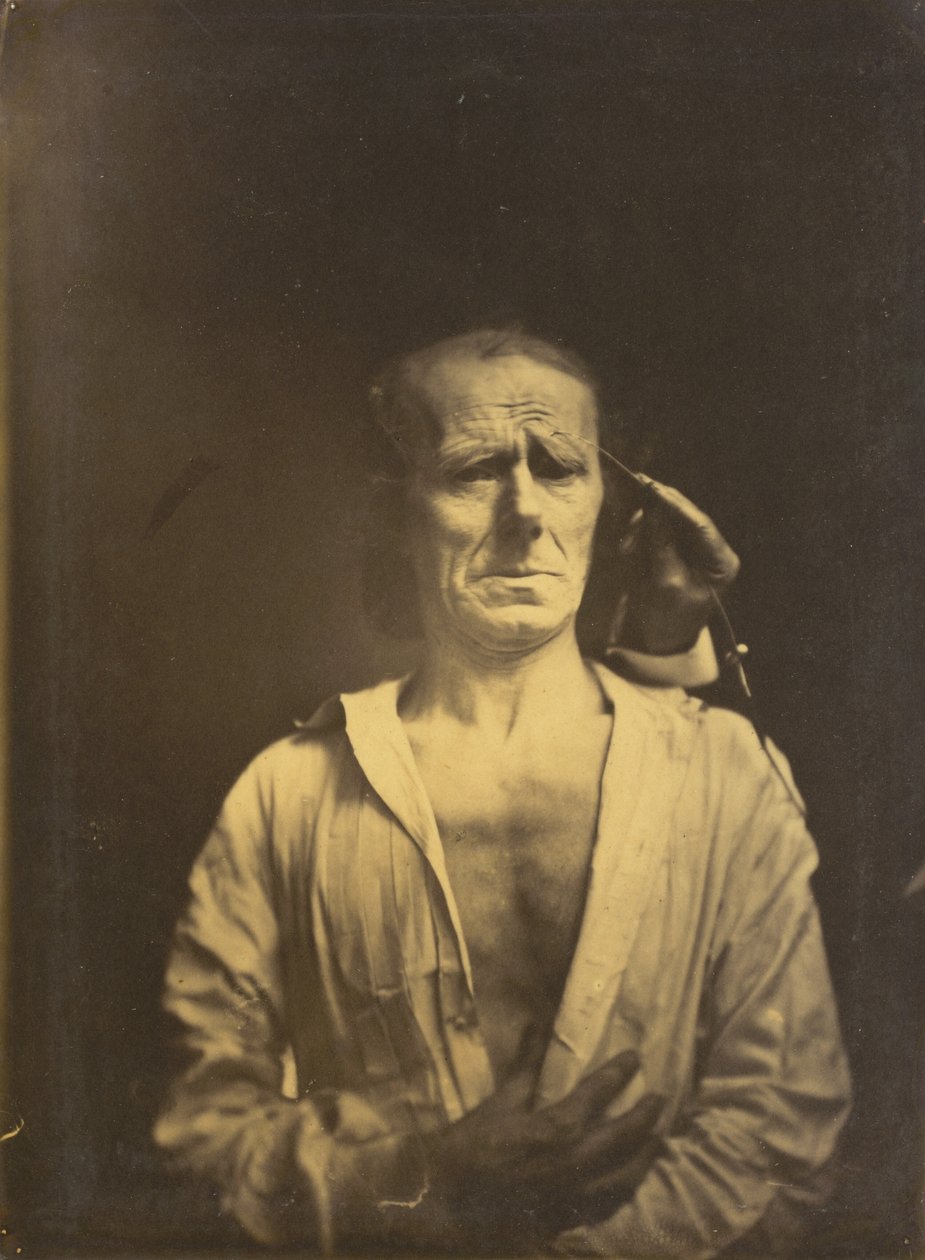 A m. corrugator supercilii görcse nagyon erős fényben (balra); Nyugodt arc (teljes napsütésben fotózva) (jobbra).
,1854-1855, nyomtatva 1862 (fénykép) alkotó: Guillaume Benjamin Armand Duchenne de Boulogne