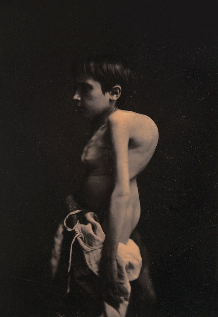 Púpos fiú portréja, 1855-57 körül alkotó: Guillaume Benjamin Armand Duchenne de Boulogne
