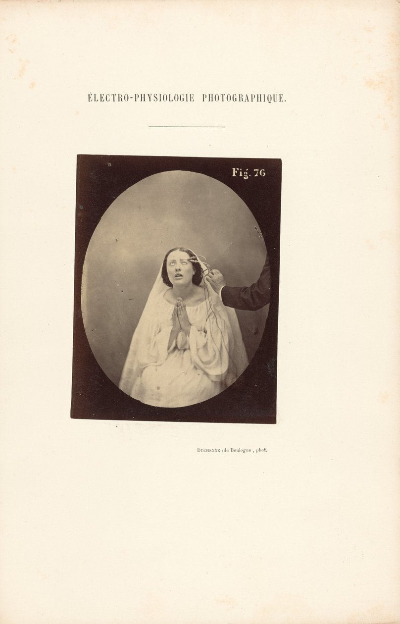 Fotográfiai elektrofiziológia, 76. ábra alkotó: Guillaume Benjamin Duchenne