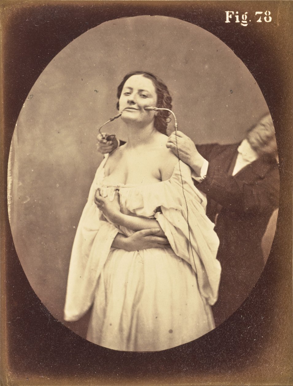 Ábra. 78 alkotó: Guillaume Benjamin Duchenne