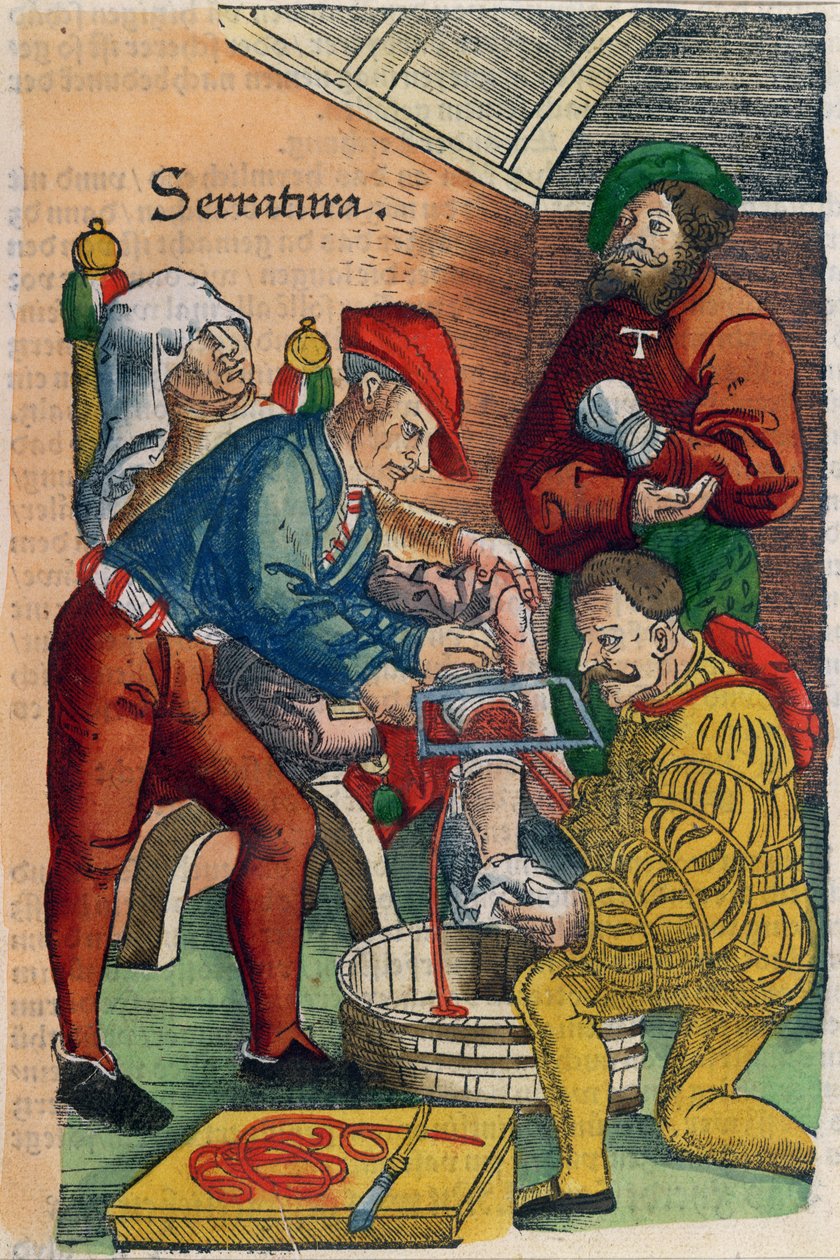 Amputáció, illusztráció Hans von Gersdorff 