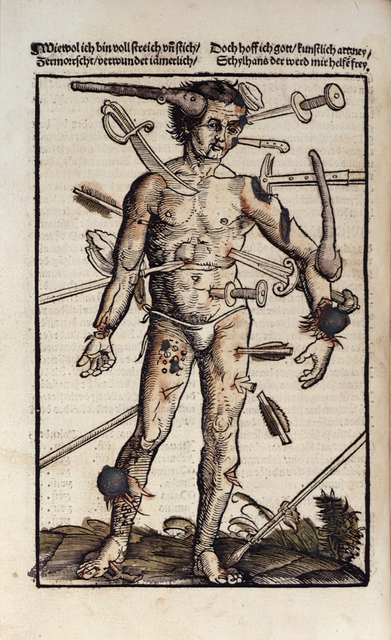 XVIIIv. A sebesült ember, Hans von Gersdorff „Feldtbuch der Wundartzney” című művéből alkotó: Hans or Johannes Ulrich Wechtlin