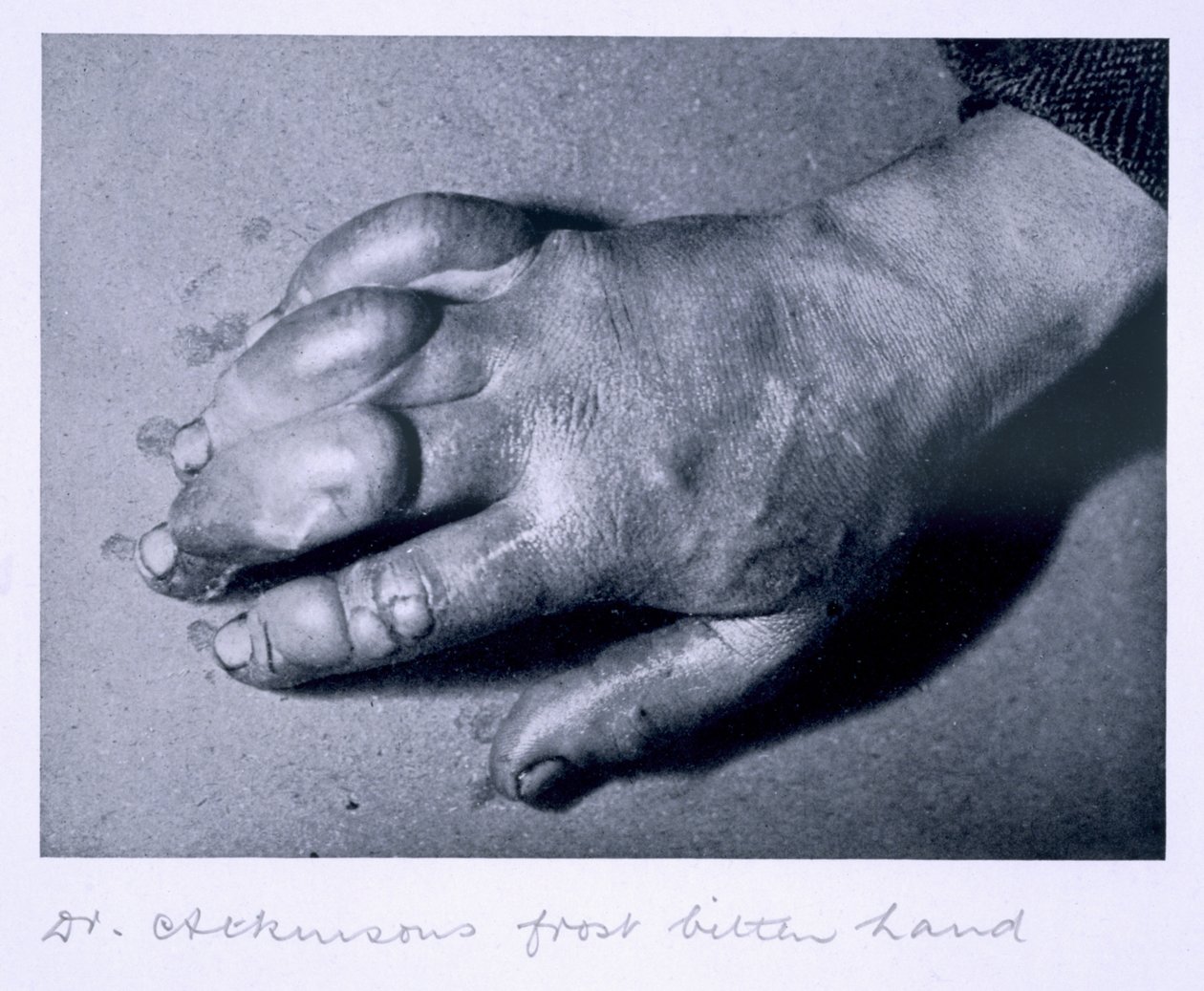 Dr. Atkinson fagycsípte keze, 1911 alkotó: Herbert Ponting