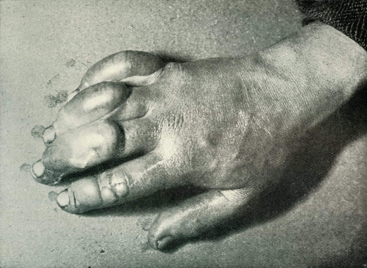 Dr. Atkinsons Frost-Bitten Hand, 1911. július 5., 1913 alkotó: Herbert Ponting