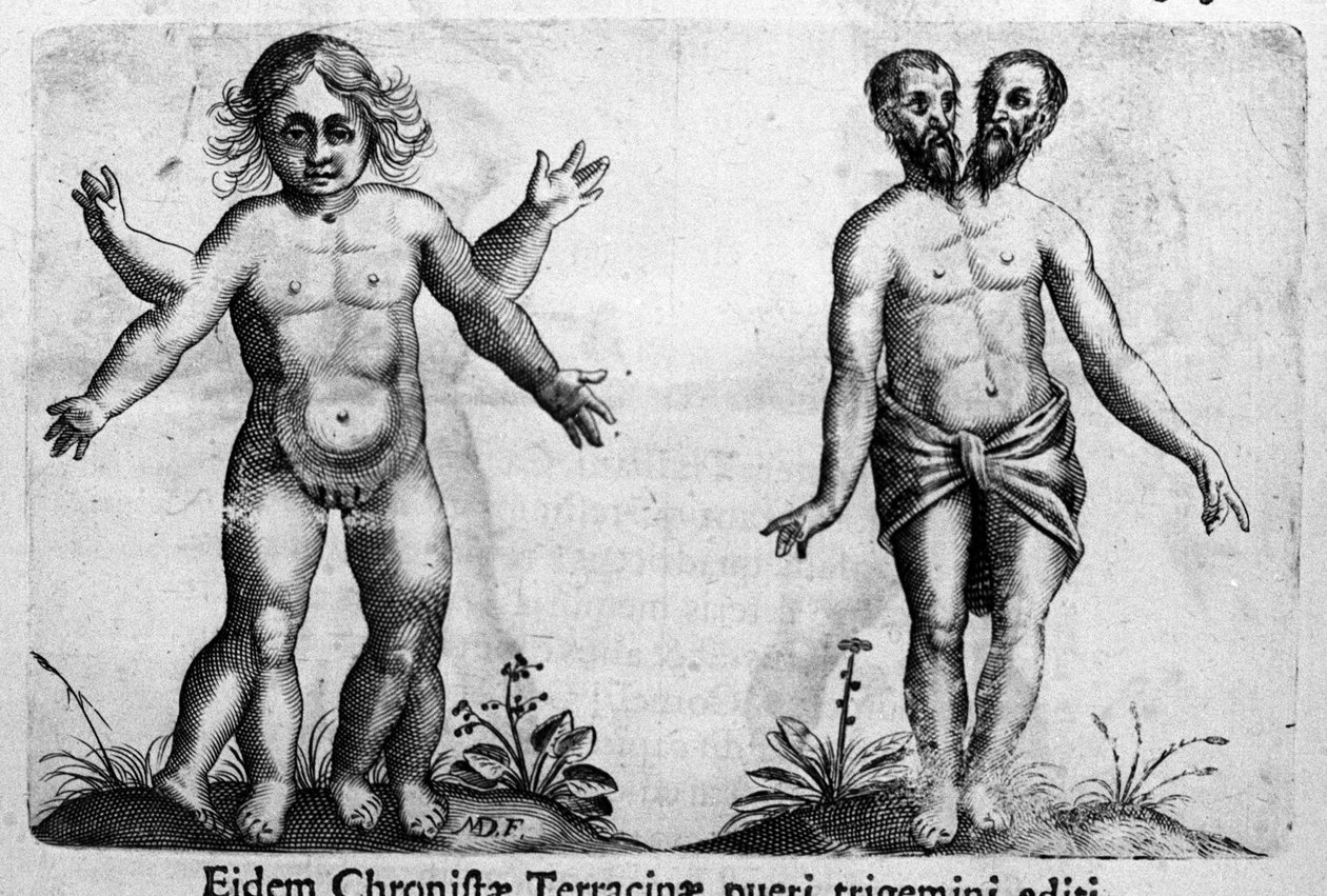 Különféle típusú emberi szörnyek Metszet Fortunio Norsi (1577-1656) olasz tudós "A szörnyek természete, okaik és különbségeik" című könyvéből. 1646 alkotó: Italian School