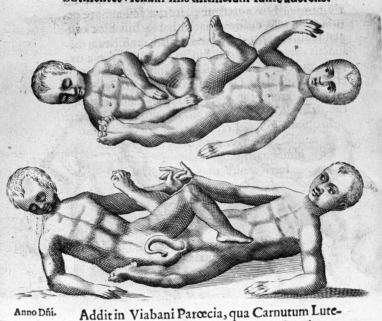 Különböző típusú emberi szörnyek: sziámi gyerekek, akiket a medence köt össze. Metszet Fortunio Norsi (1577-1656) olasz tudós "A szörnyek természete, okaik és különbségeik" című könyvéből. 1646 alkotó: Italian School