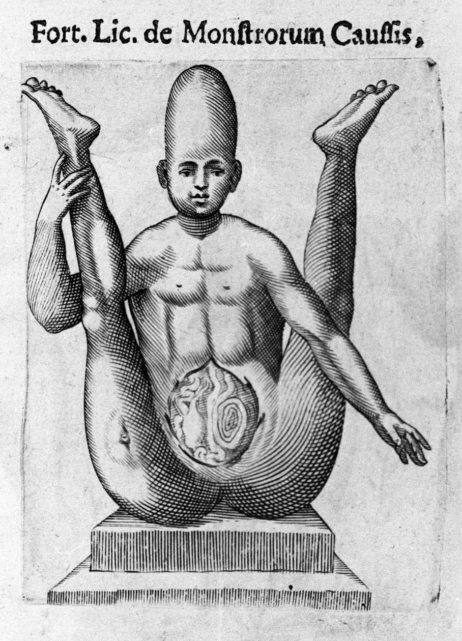 Emberi szörny: hatalmas koponyájú lény, látszólagos belekkel. Metszet Fortunio Norsi (1577-1656) olasz tudós "A szörnyek természete, okaik és különbségeik" című könyvéből. 1646 alkotó: Italian School