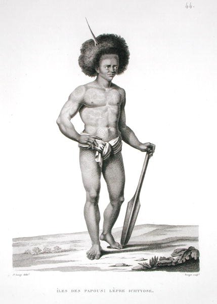 Pápua-szigetek: Lepra áldozata, a „Voyage Autour du Monde (1817-20)”-ból, Louis Claude Desaulses de Freycinet (1779-1842) vésette Forget, megjelent 1822-24 (litho) alkotó: Jacques Etienne Victor (after) Arago