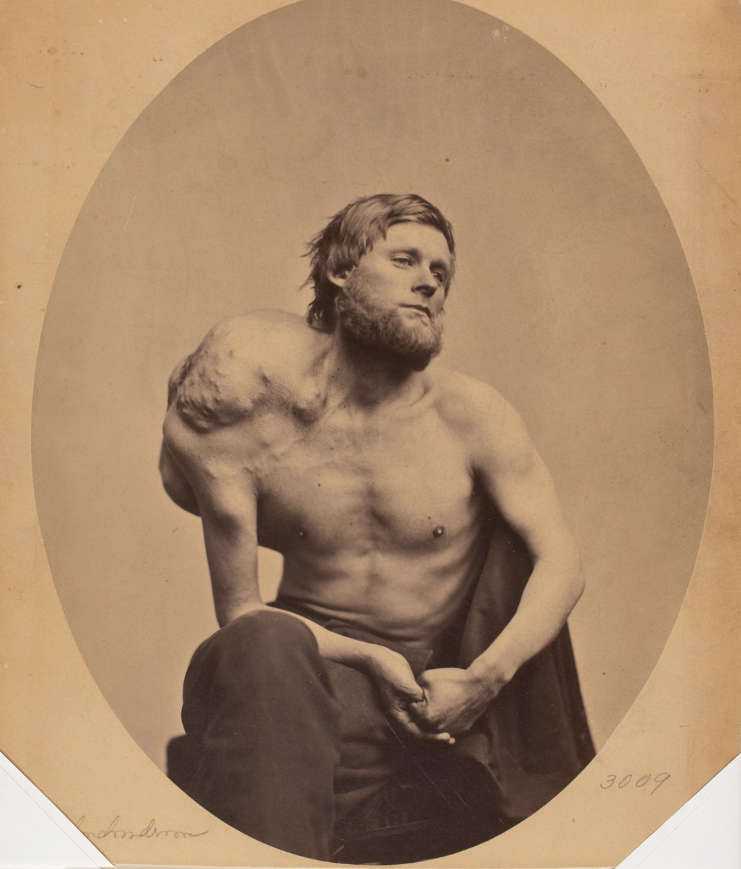 A lapocka enchondroma alkotó: James Wallace Black