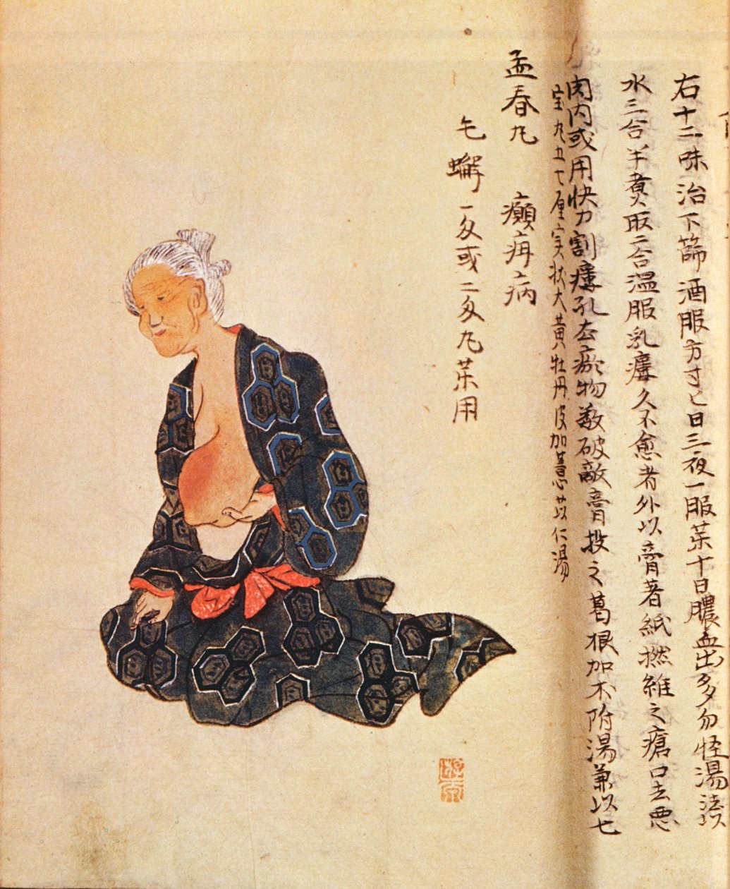 Seishu Hanaoka (1760-1836) az emlőrák első sebészeti kezelését általános érzéstelenítésben végezte 1804-ben alkotó: Japanese School