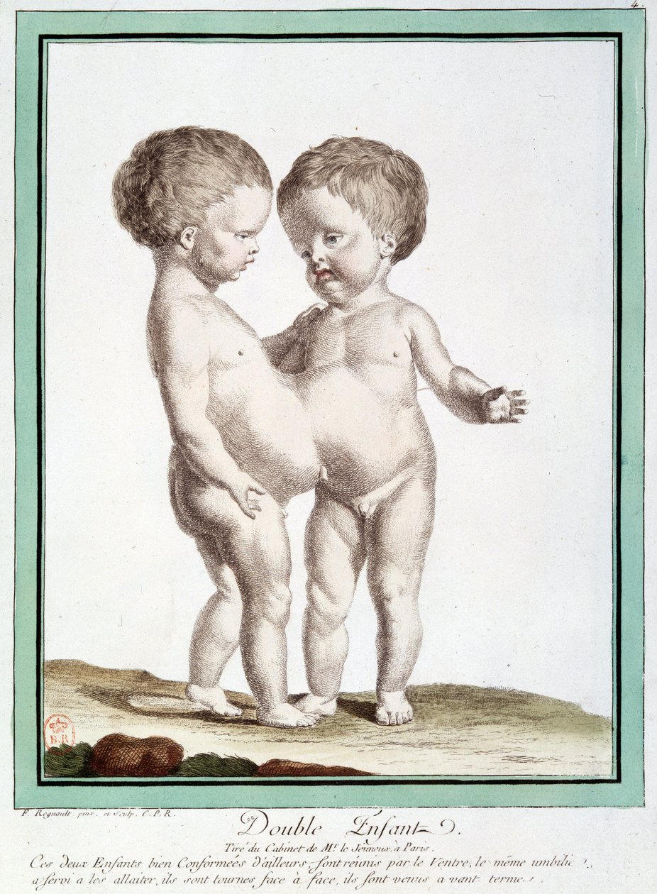 Sziámi gyerekek – Régnault „A természet eltérései” c alkotó: Jean Baptiste Regnault