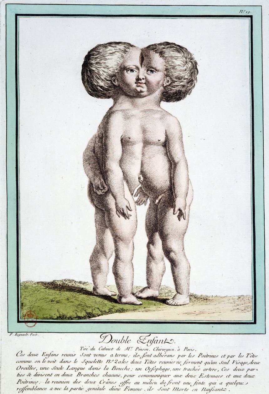 Sziámi gyerekek – Régnault „A természet eltérései” c alkotó: Jean Baptiste Regnault