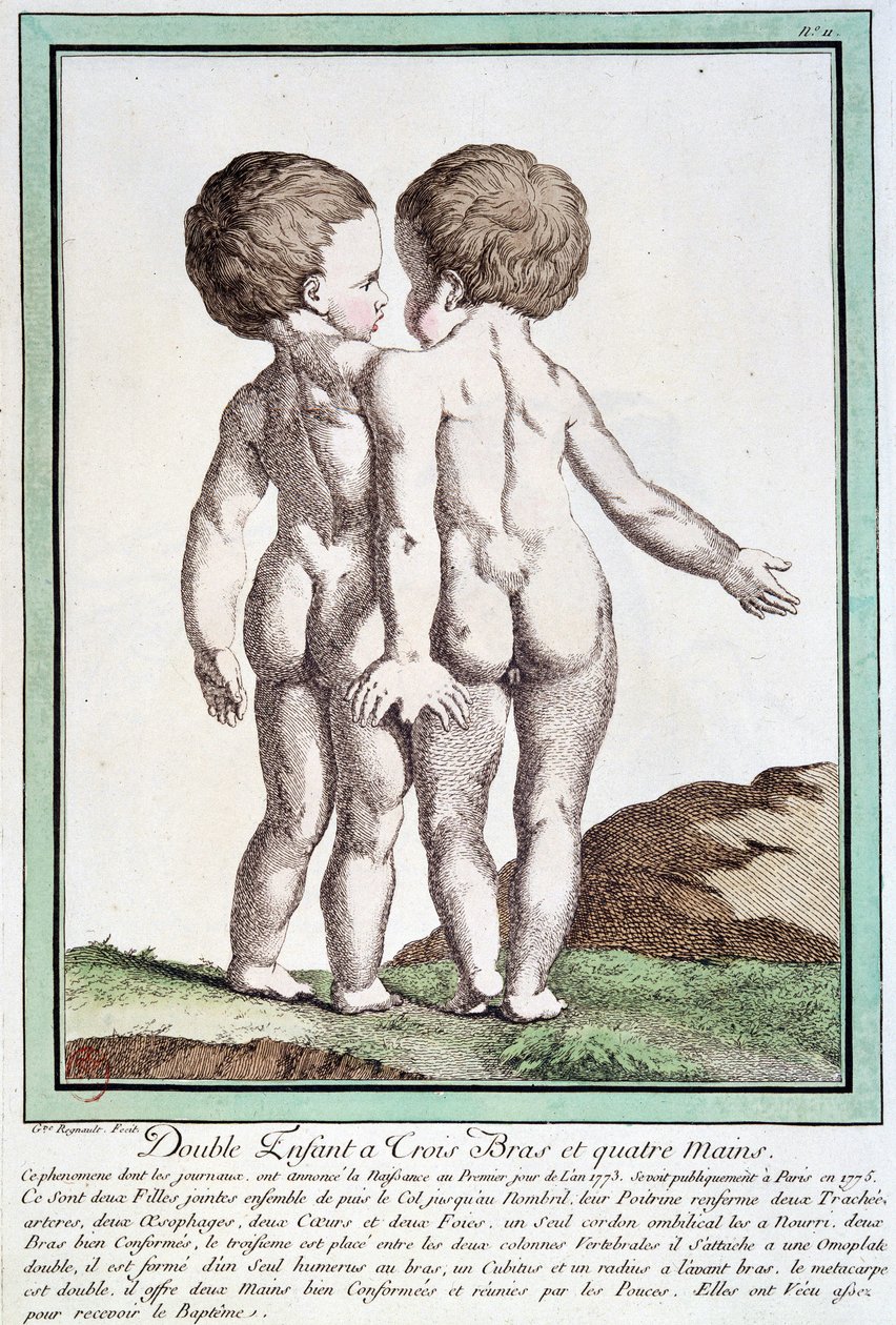 Sziámi gyerekek – Régnault „” Les deviations de la nature” című könyvében alkotó: Jean Baptiste Regnault