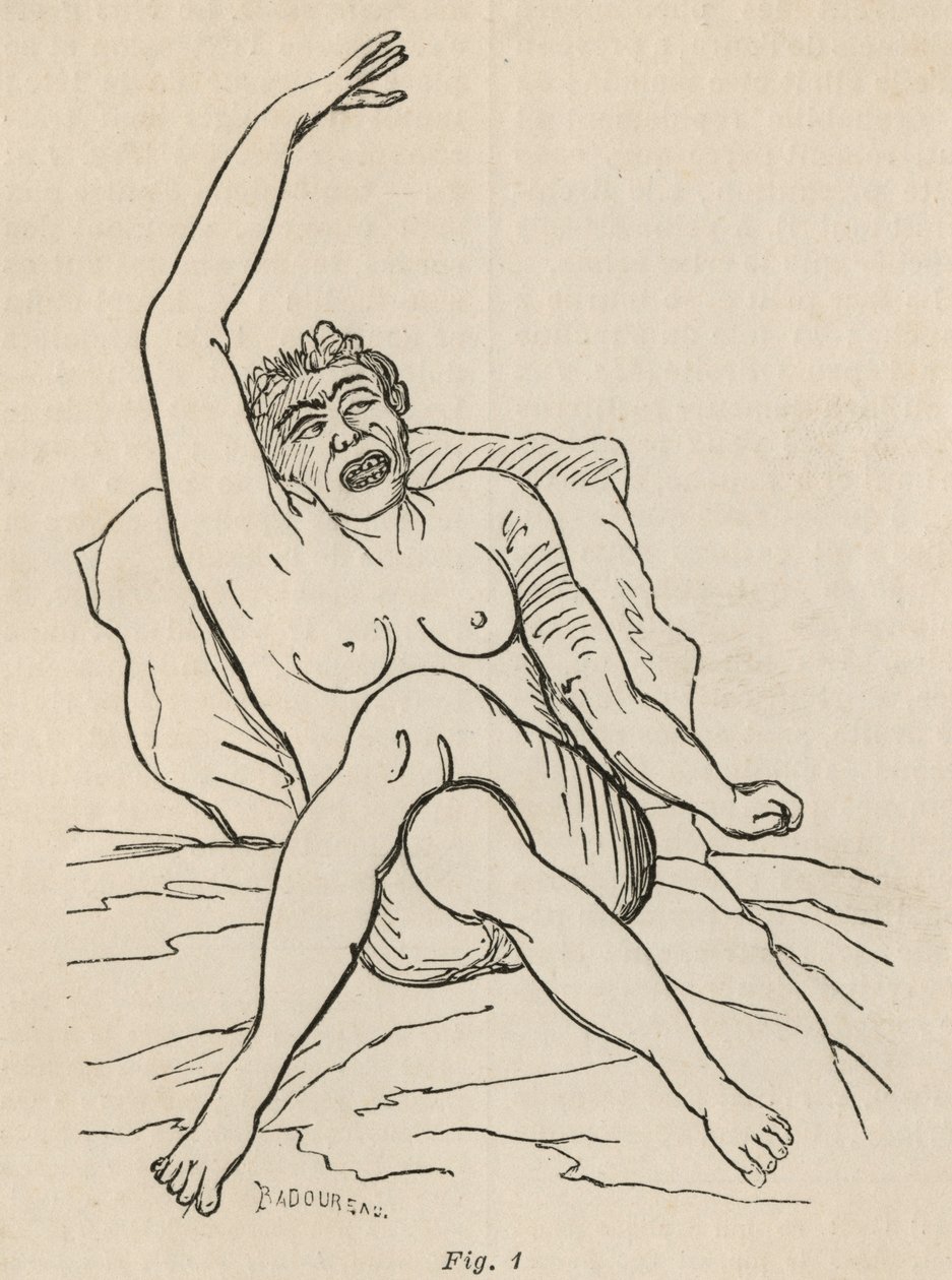 Hisztérikus epilepszia, roham, görcsök, 1. ábra a Bourneville et P. által készített "Iconographie Photographique de La Salpetriere" című képből. Regnard, Párizs, 1876 alkotó: Jean Francois Badoureau