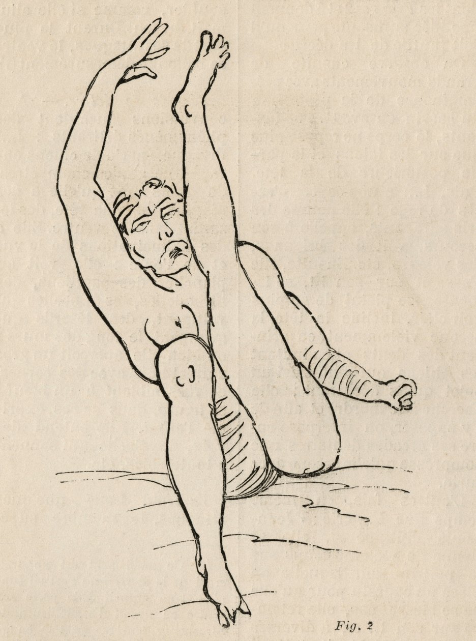 Hisztérikus epilepszia, roham, torzulások, ábra. 2. Bourneville és P. Regnard „Iconographie Photographique de La Salpetriere” című művéből, Párizs, 1876 alkotó: Jean Francois Badoureau