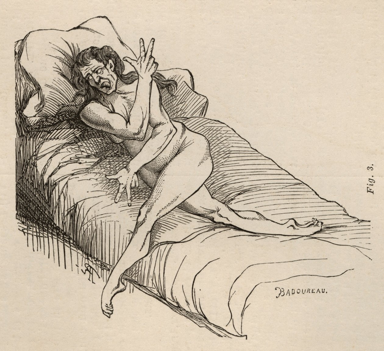 Hisztérikus epilepszia, roham, torzulások, ábra. 3. Bourneville és P. Regnard „Iconographie Photographique de La Salpetriere” című művéből, Párizs, 1876 alkotó: Jean Francois Badoureau