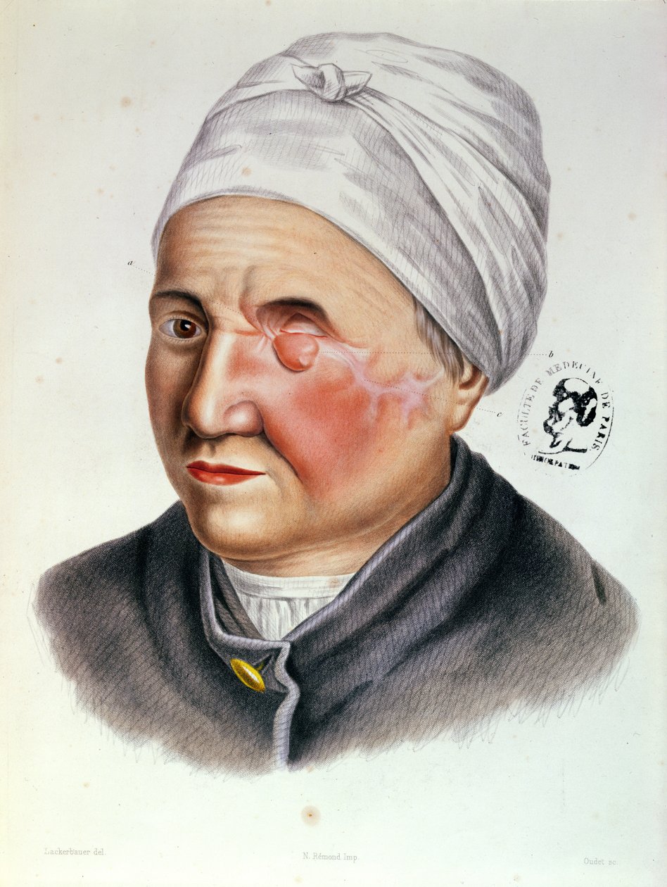 Illusztráció a Traite de Chirurgie Plastique-ból, Antoine Jobert de Lamballe (1799-1867) Párizs, 1849 alkotó: Lackerbauer