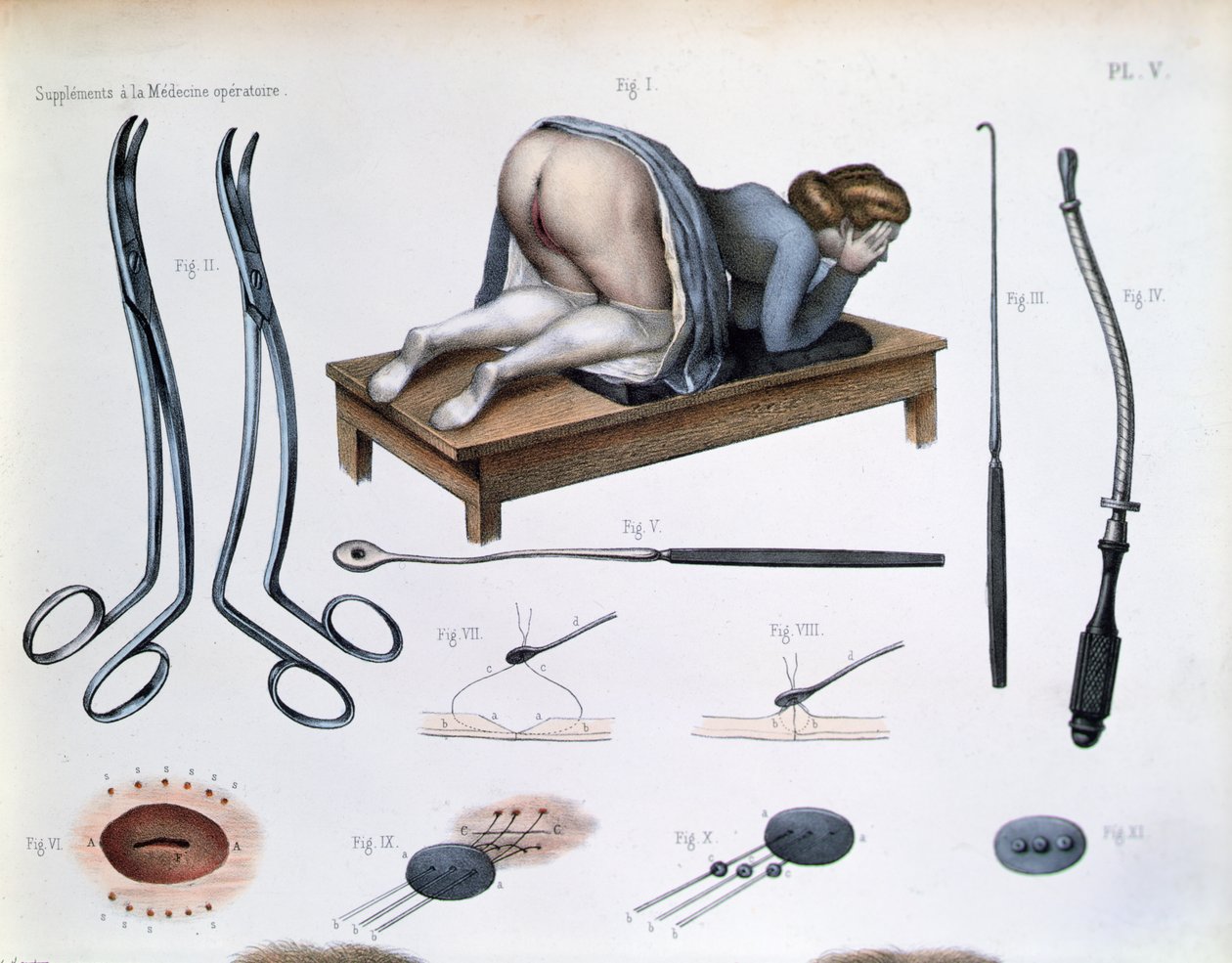 Hólyagos-vaginális sipoly műtétje, Jean-Baptiste Marc Bourgery (1797-1849) „Traite Complet de l