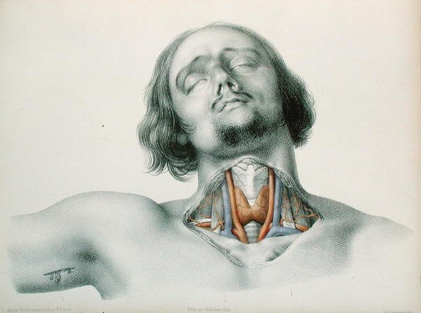 A torok keresztmetszete, Jean-Baptiste-Leon Dubreuil „Anomalies Arterielles” című művéből alkotó: Nicolas Henri Jacob