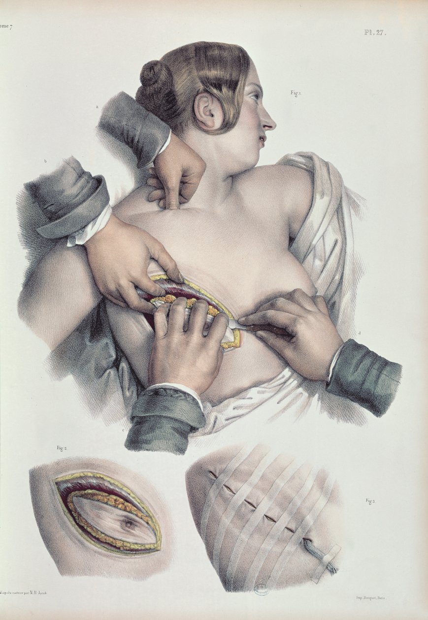 Rákos daganat műtétje, Jean-Baptiste Marc Bourgery (1797-1849) „Traite Complet de l