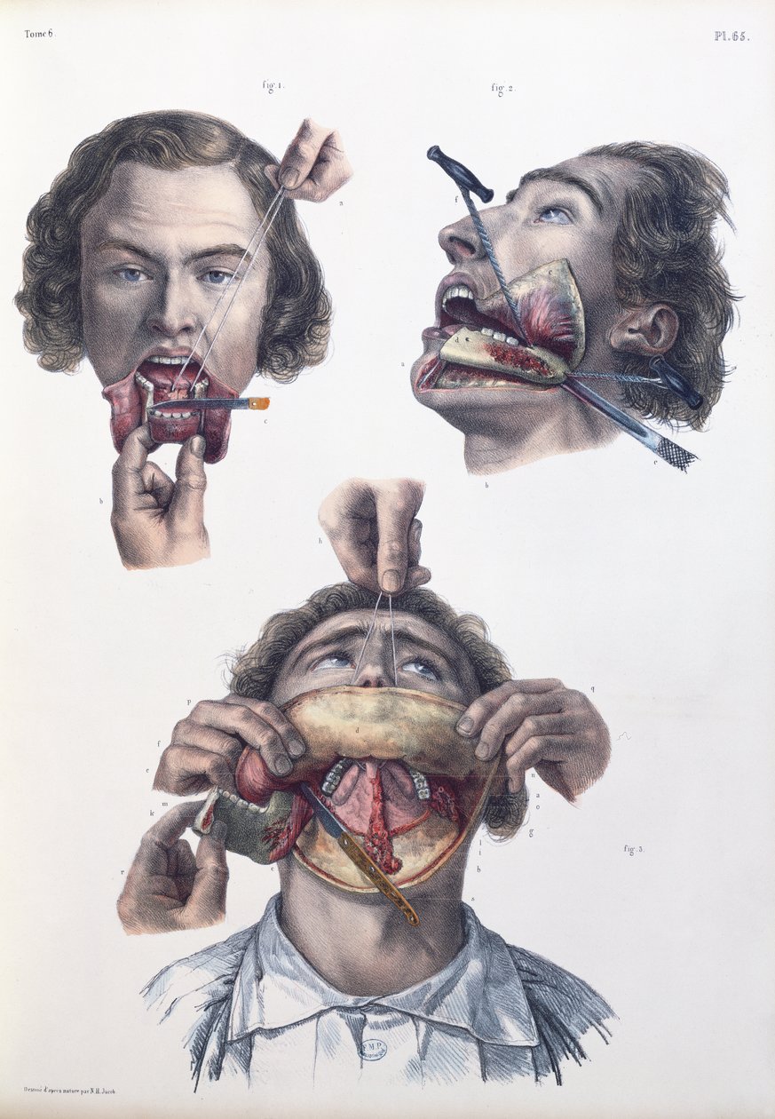 Műtét az alsó állkapcson, Jean-Baptiste Marc Bourgery (1797-1849) „Traite Complet de l