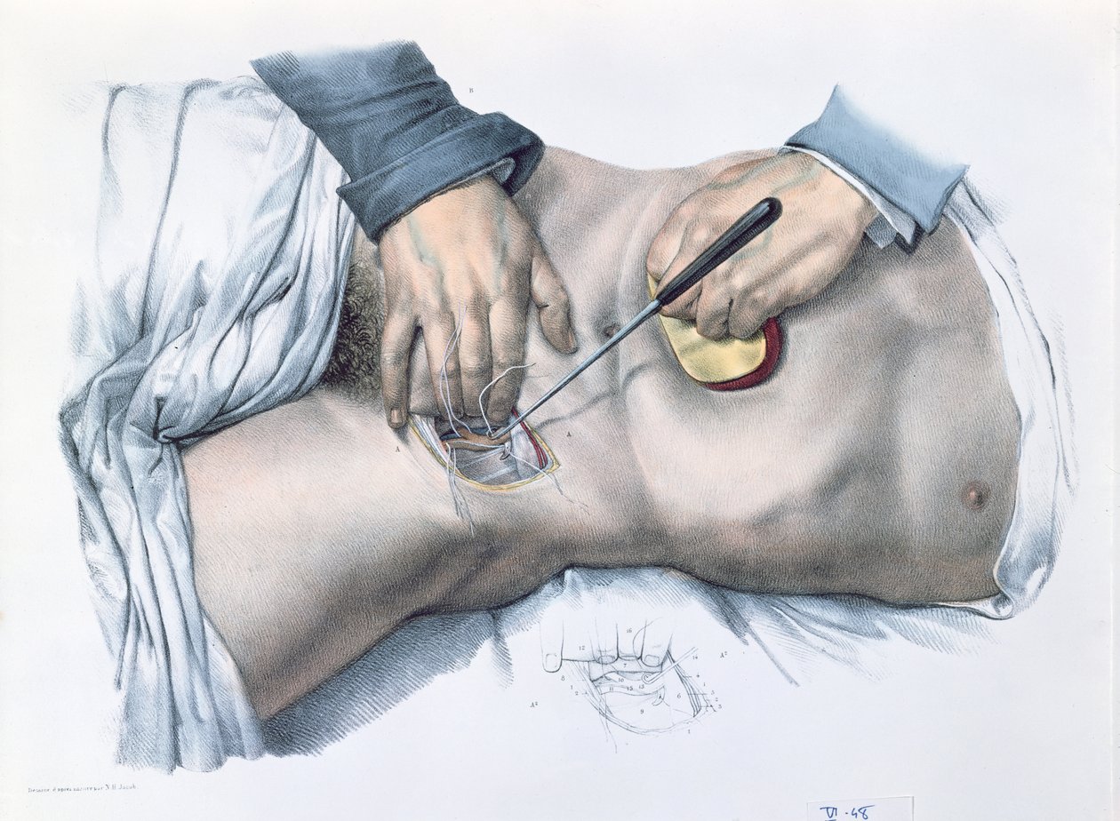 Artéria lekötése, lemez a „Traite Complet de l
