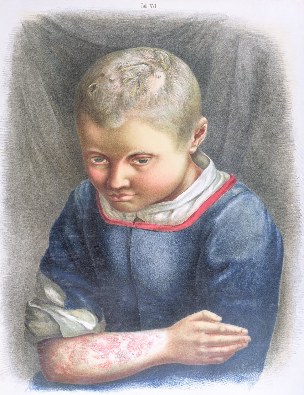 Favus, Daniel Cornelius Danielssen (1815-94) könyvéből, 1892 alkotó: Norwegian School