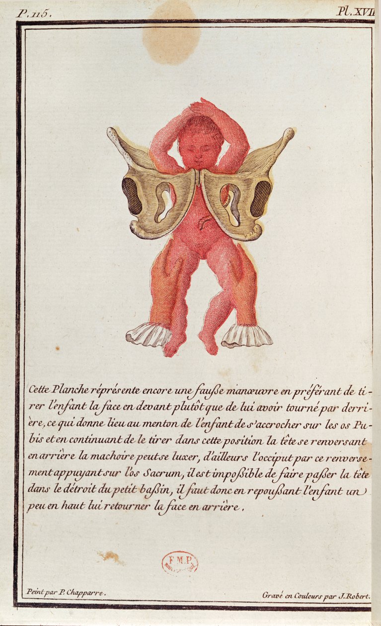 Az anyaméhből a lábánál fogva kihúzott baba keresztmetszeti diagramja Madame Angelique Le Boursier du Coudray (1714-94) J. Robert által metszett könyvéből, 1783 alkotó: P. Chapparre