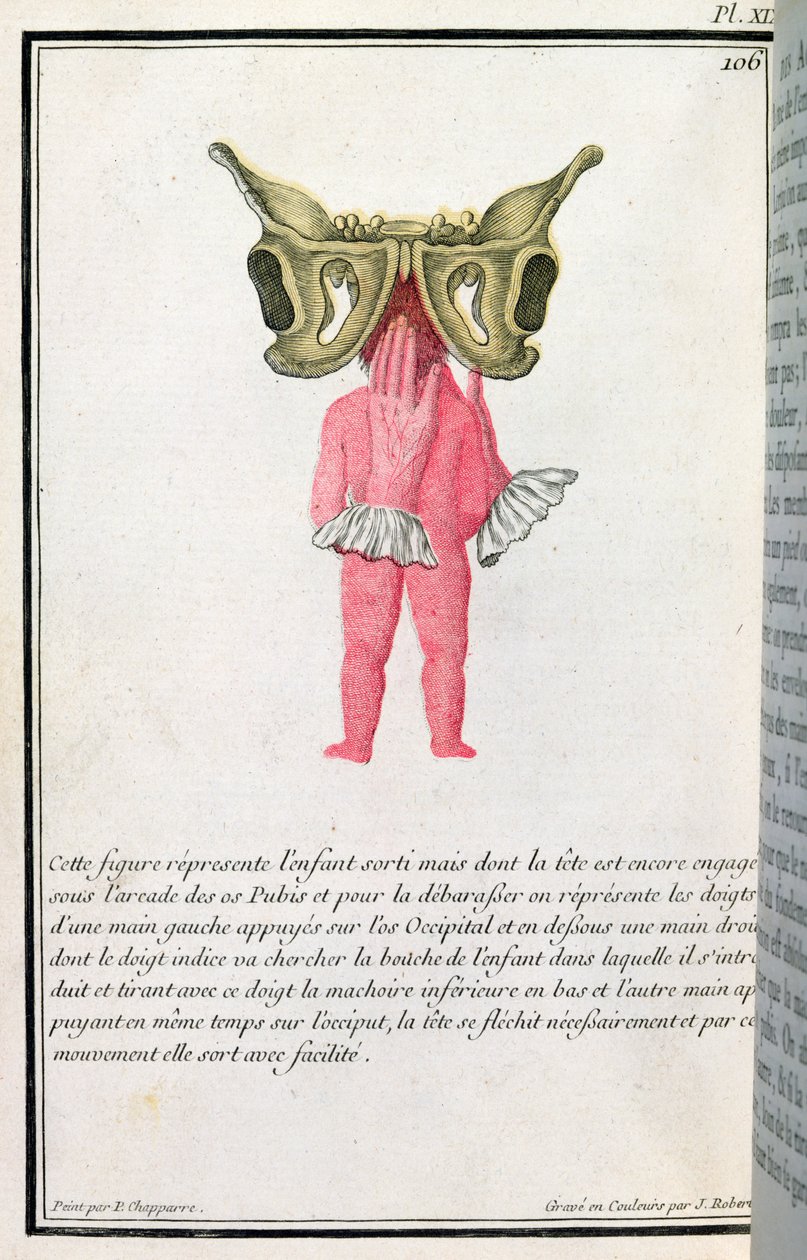 Az anyaméhből kihúzott csecsemő keresztmetszeti diagramja Madame Angelique Le Boursier du Coudray (1714-94) J. Robert által metszett könyvéből, 1783 alkotó: P. Chapparre