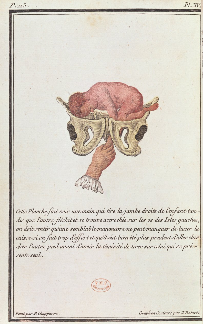 Az anyaméhből a karjánál fogva kihúzott baba keresztmetszeti diagramja Madame Angelique Le Boursier du Coudray (1714-94) J. Robert által metszett könyvéből, 1783 alkotó: P. Chapparre