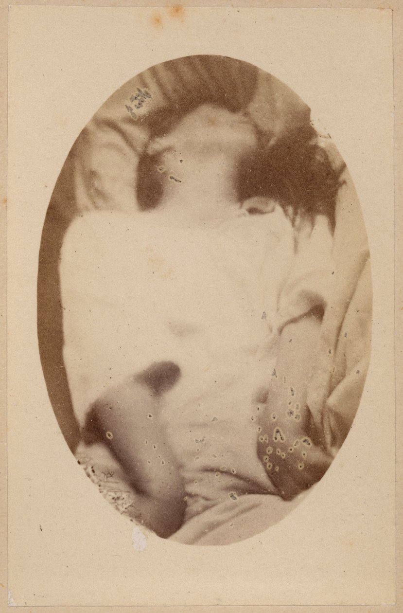 Hisztérikus epilepszia, roham, epileptoid fázis, Bourneville et P. Regnard „Iconographie Photographique de La Salpetriere” illusztrációja, XVII. tábla, Párizs, 1876 (albumnyomat) alkotó: Paul Regnard