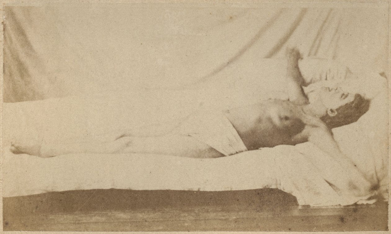 Hisztérikus epilepszia, roham, keresztre feszítés, VI. tábla az „Iconographie Photographique de La Salpetriere”-ből, Bourneville et P. Regnard, Párizs, 1876 (albumnyomat) alkotó: Paul Regnard