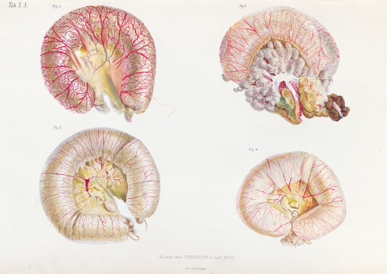 A kolerával fertőzött belek külső felülete az Anatomie Pathologique du Cholera Morbus-tól, Nyikolaj Ivanovics Pirogov (1810-81) Szentpéterváron, 1849 alkotó: Russian School