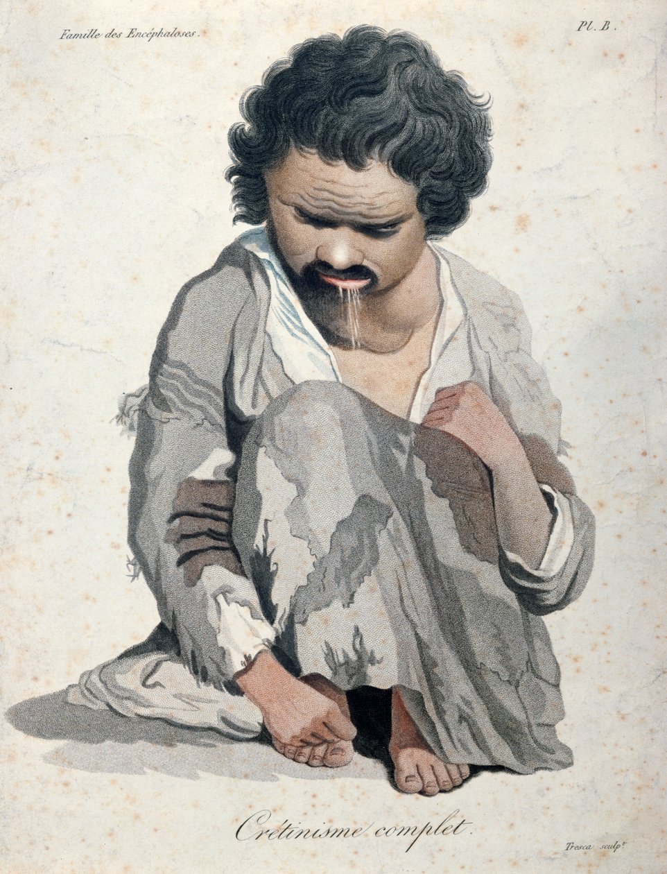 Totális kreténizmus, Jean Louis Alibert báró (1768-1837) könyvéből alkotó: Salvadore Tresca