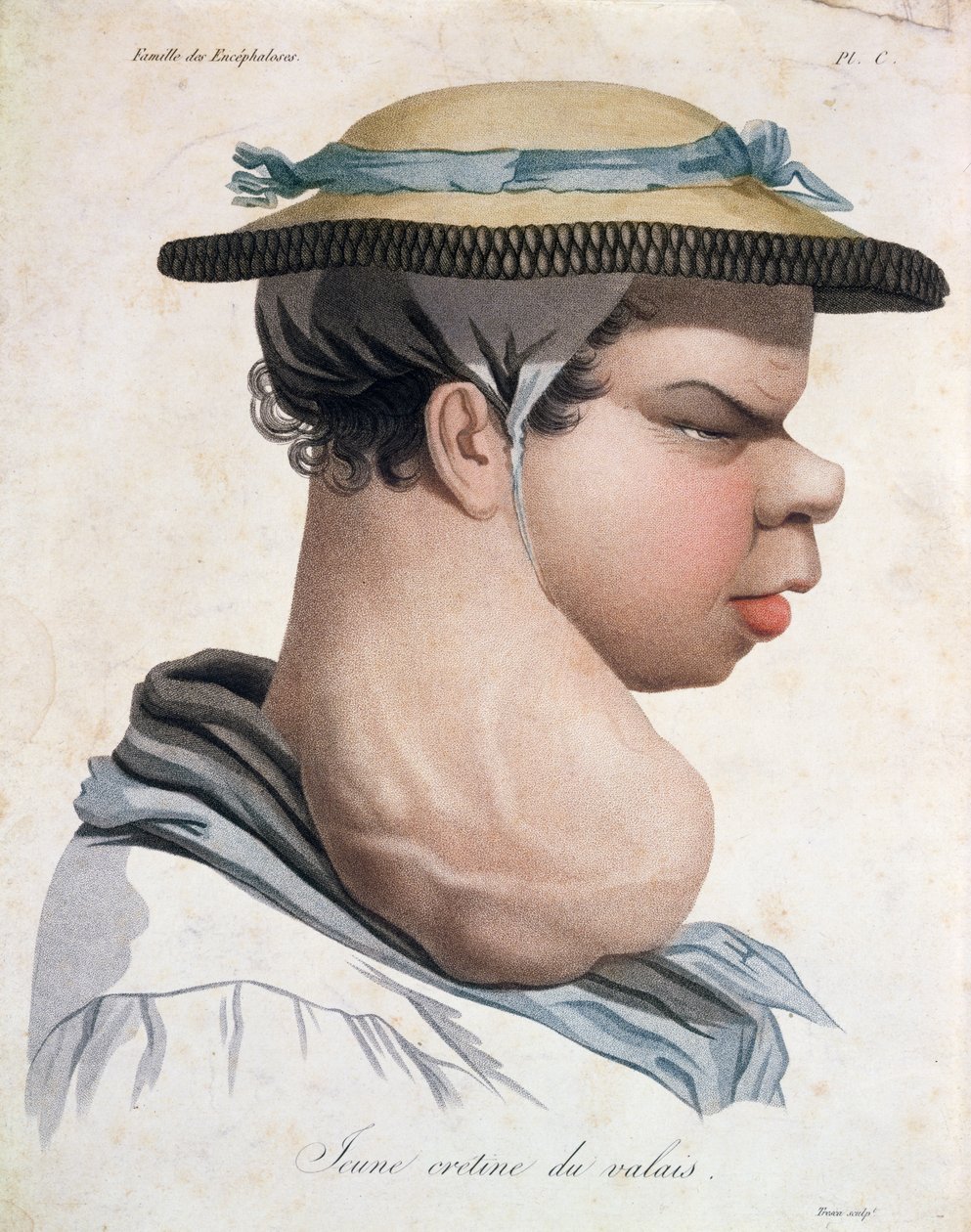 Fiatal kretén Valais-ból, illusztráció Jean Louis Alibert báró (1768-1837) könyvéből alkotó: Salvadore Tresca