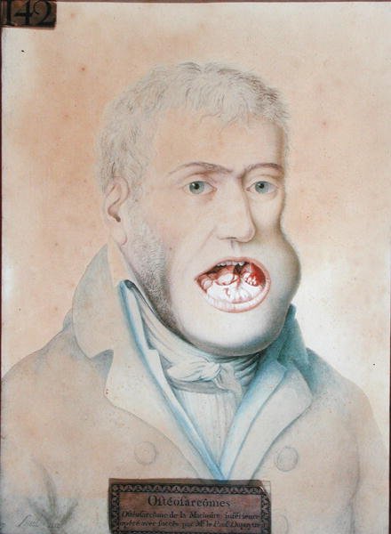 Guillaume Dupuytren (1777-1835) sikeresen operált alsó állkapocs osteosarcoma (ceruza papíron) alkotó: School French