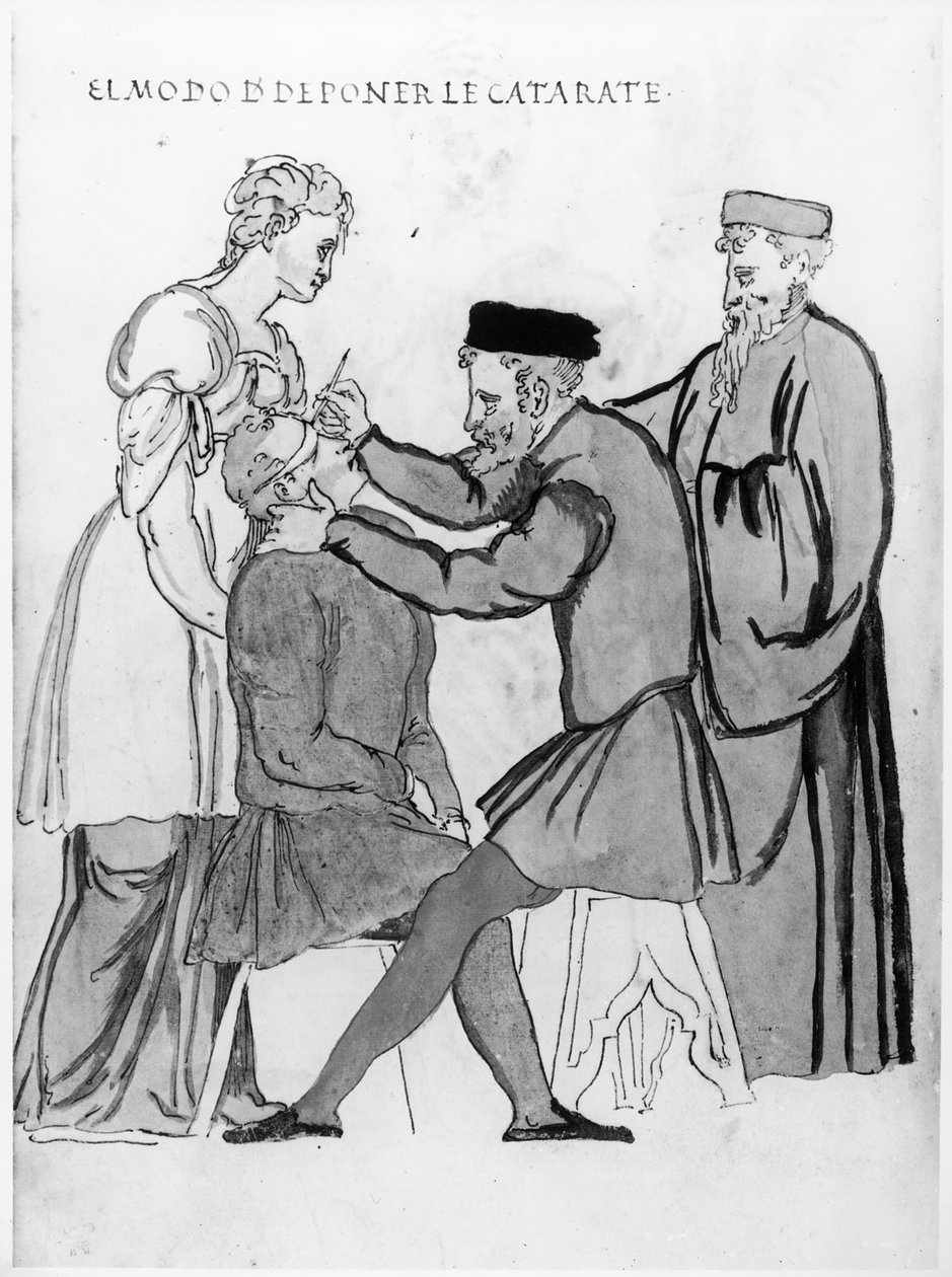 Szemműtét szürkehályog eltávolítására (toll és tinta papíron) alkotó: Spanish School