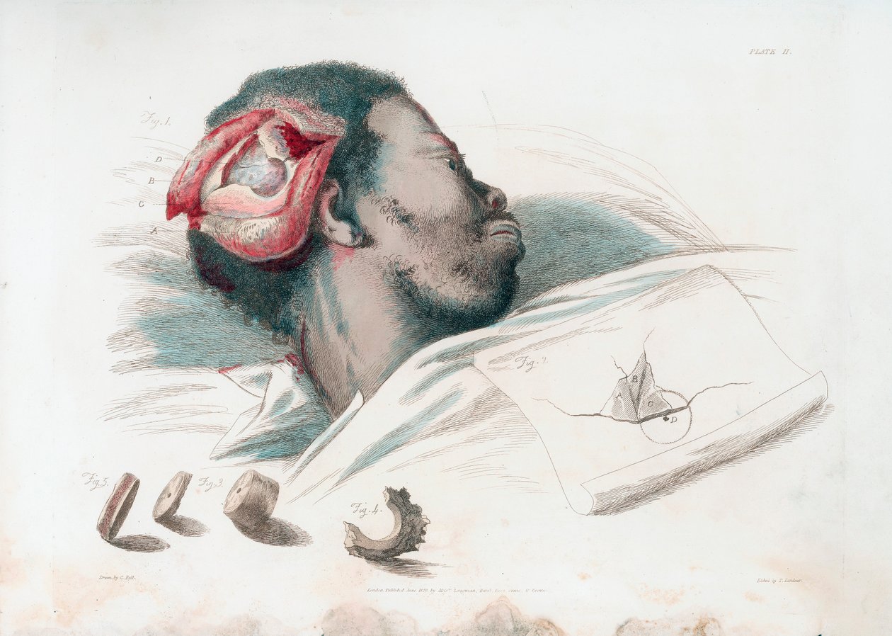 A koponya sebének képe trephinálás és az összetört csontdarab eltávolítása után a bal alsó sarokban, 1821 alkotó: Thomas Landseer