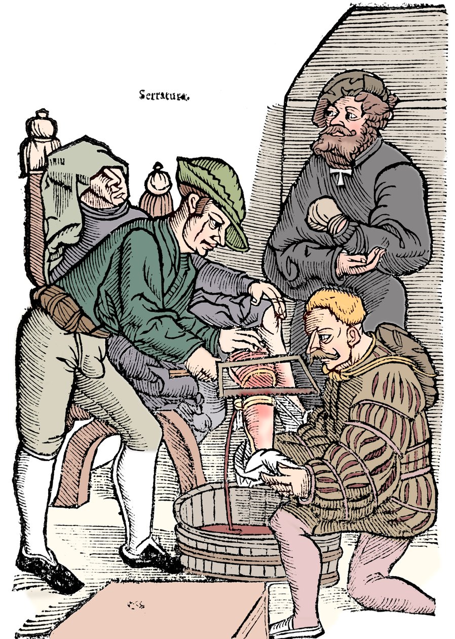 Láb amputációja érzéstelenítés nélkül, 1593 alkotó: Unbekannt