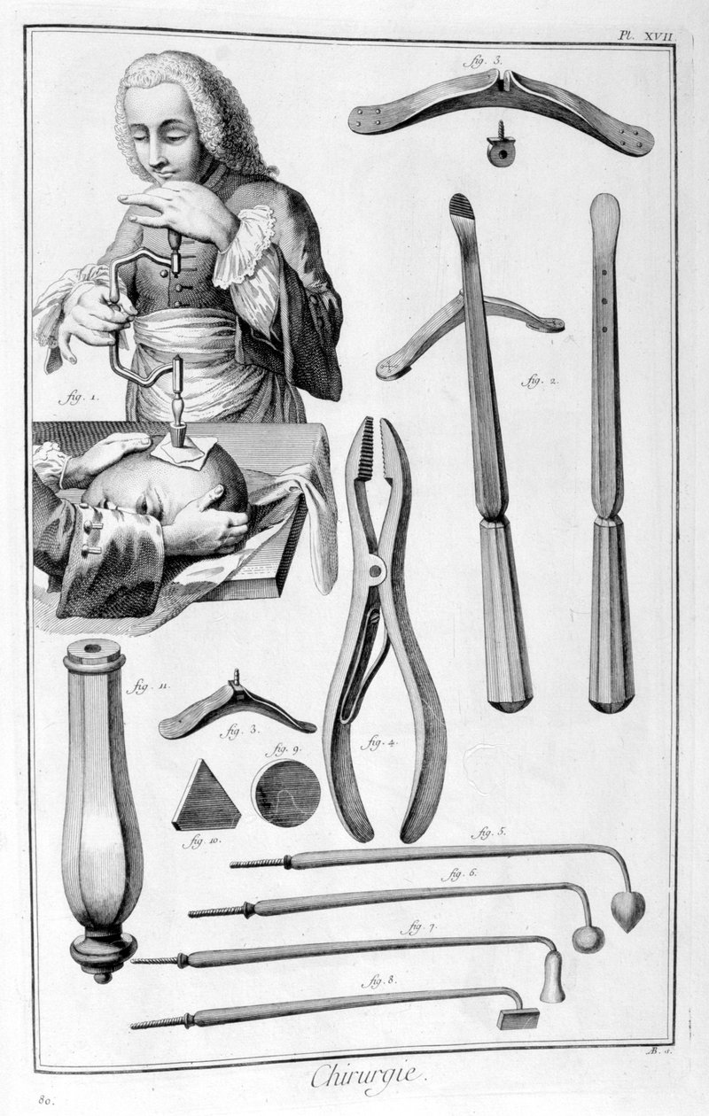 Fejsebészet, 1751-1777 alkotó: Unbekannt