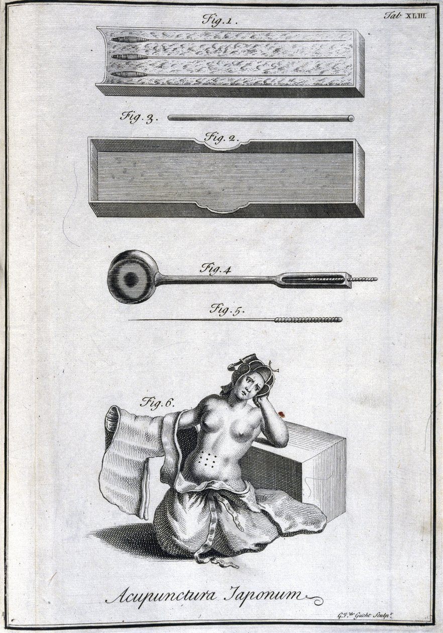 Alternatív gyógyászat: akupunktúrás tűket és alkalmazásukat ábrázoló tábla, metszet Engelbert Kaempfer (1651-1716) „Japán történetéből” (1727) (Akupunktúrás tűk és alkalmazásuk, c 1690 Metszet: G van der Gucht ábra alkotó: Unbekannt